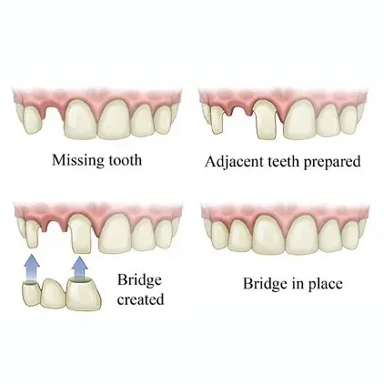 graphic of how dental bridges work