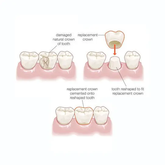 graphic of how dental crowns work