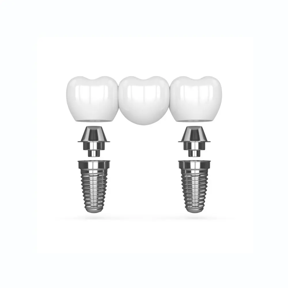 multi-tooth implant bridge