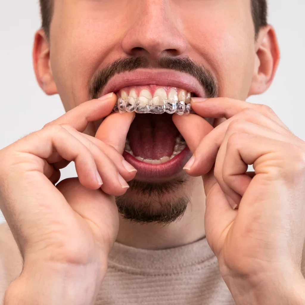 man putting on invisalign clear teeth aligners to straighten his teeth without braces | invisalign Redondo Beach, CA