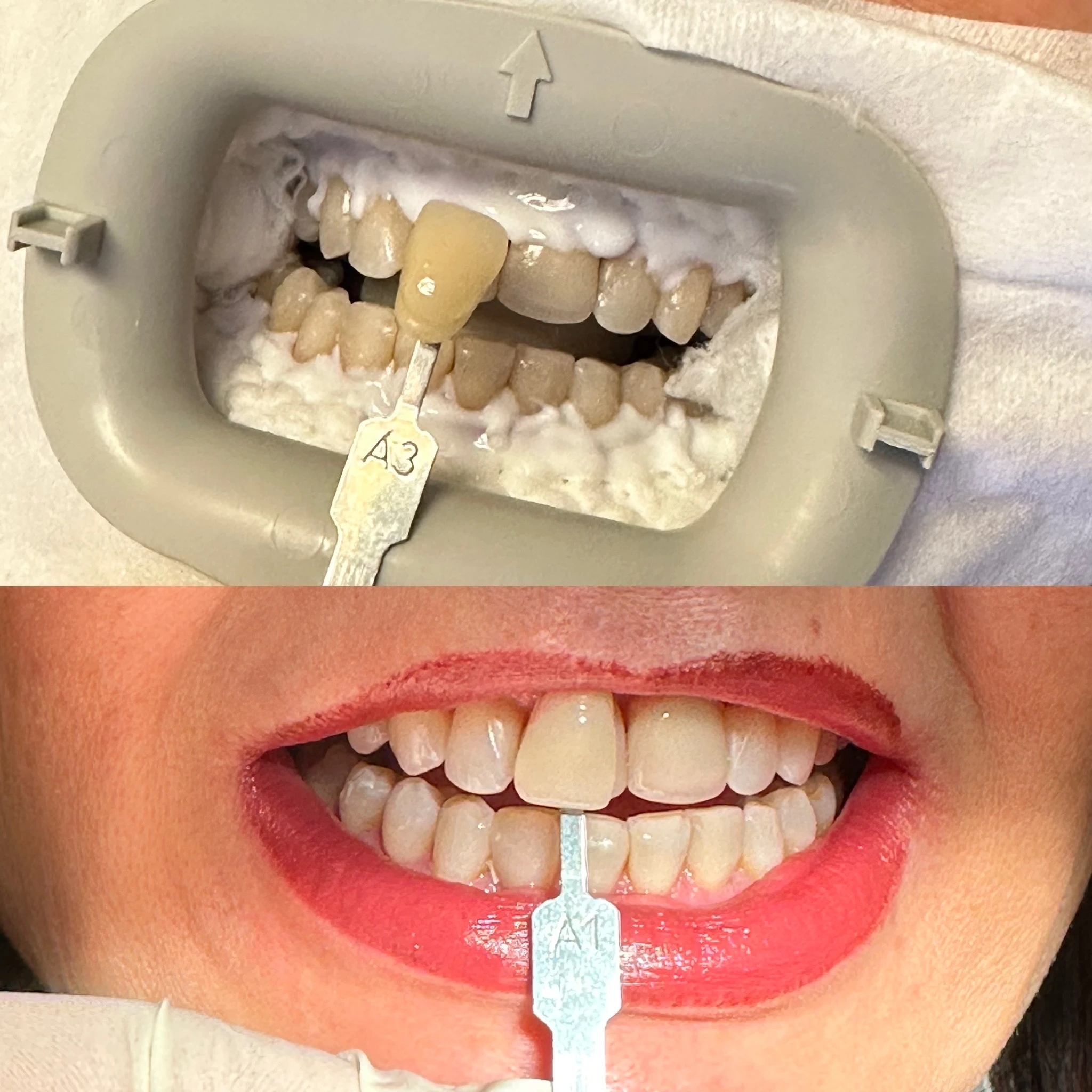 before and after professional teeth whitening at Redondo Beach Dental Arts