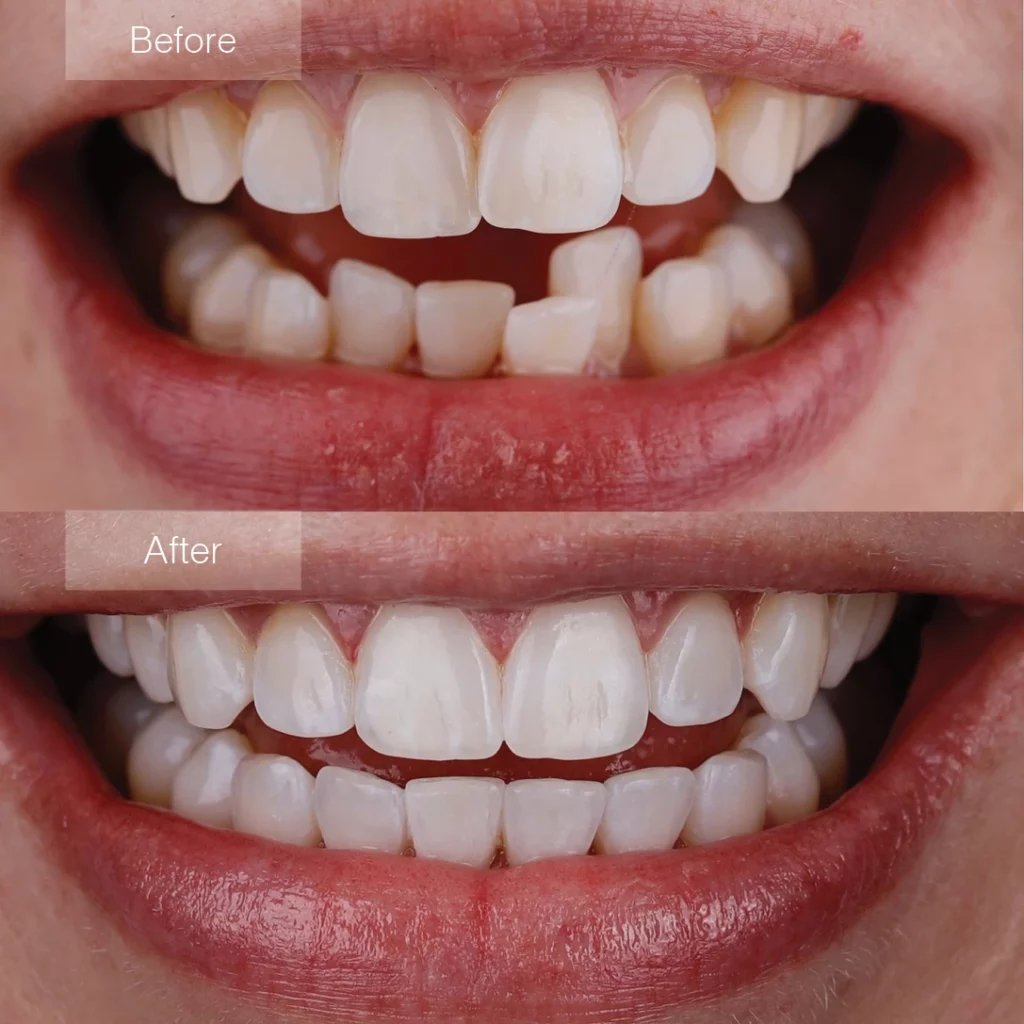 before and after Invisalign Redondo Beach, CA