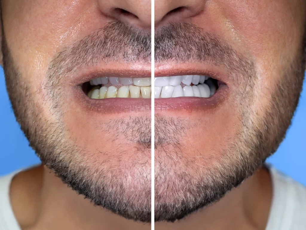 before and after professional teeth whitening in Redondo Beach, CA