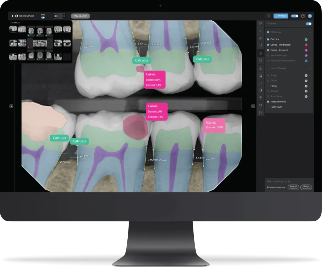 Computer monitor showing Overjet AI - the latest AI dental technology